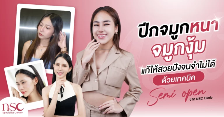 ปีกจมูกหนา จมูกงุ้ม แก้ให้สวยปังจนจำไม่ได้ ด้วยเทคนิค Semi Open จาก NSC Clinic