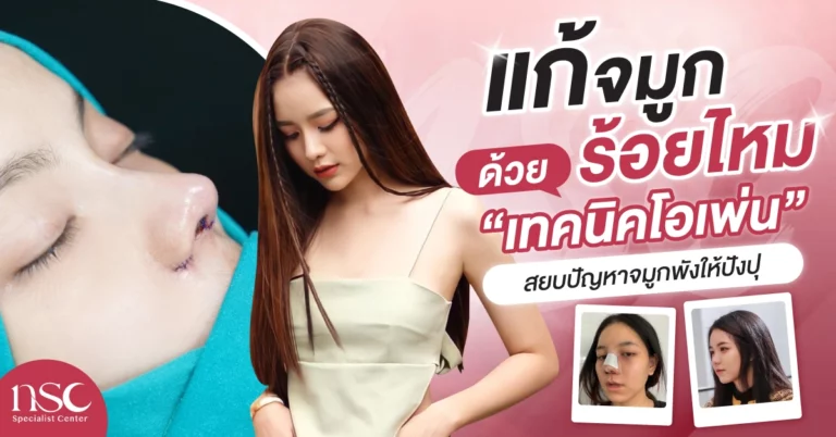 แก้ จมูกร้อยไหม ด้วย “เทคนิคโอเพ่น” สยบปัญหาจมูกพังให้ปังปุ