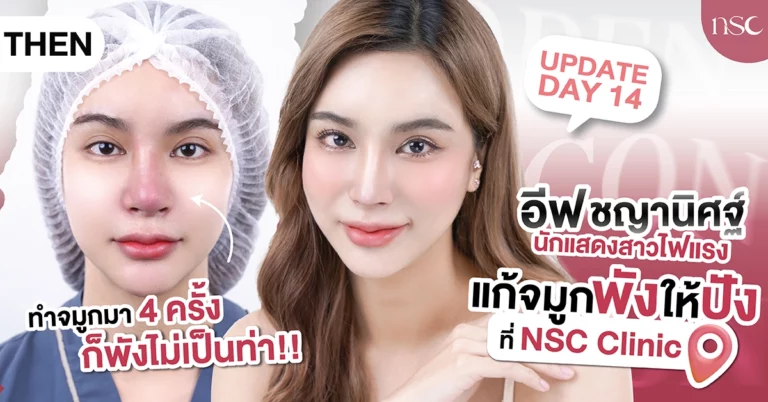 ทำจมูกมา 4 ครั้ง ก็พังไม่เป็นท่า! อีฟ ชญานิศฐ์  นักแสดงสาวไฟแรง แก้จมูกจากพังให้ปังที่ NSC Clinic