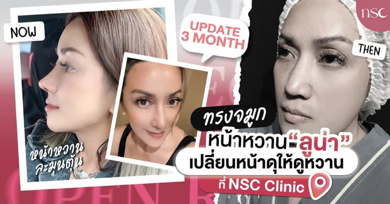 ทรงจมูกหน้าหวาน “ลูน่า” ทรงจมูกเปลี่ยนหน้าดุให้หวานฉ่ำ ที่ NSC Clinic เท่านั้น