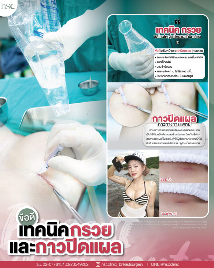 เสริมหน้าอก กรวย