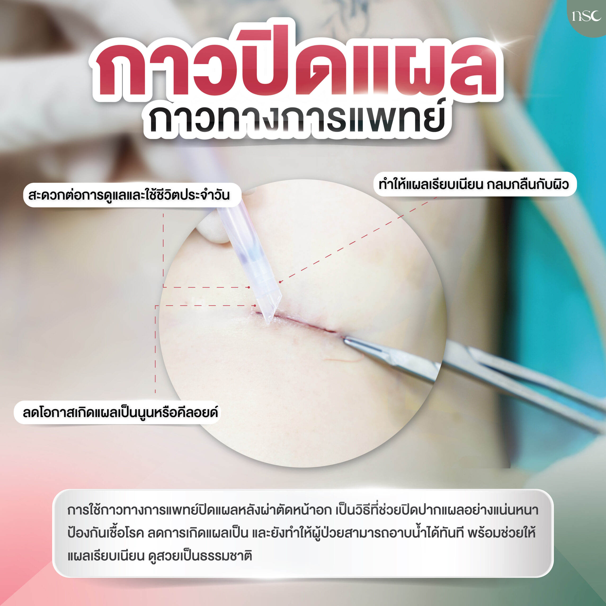 เสริมหน้าอก กาวปิดแผล